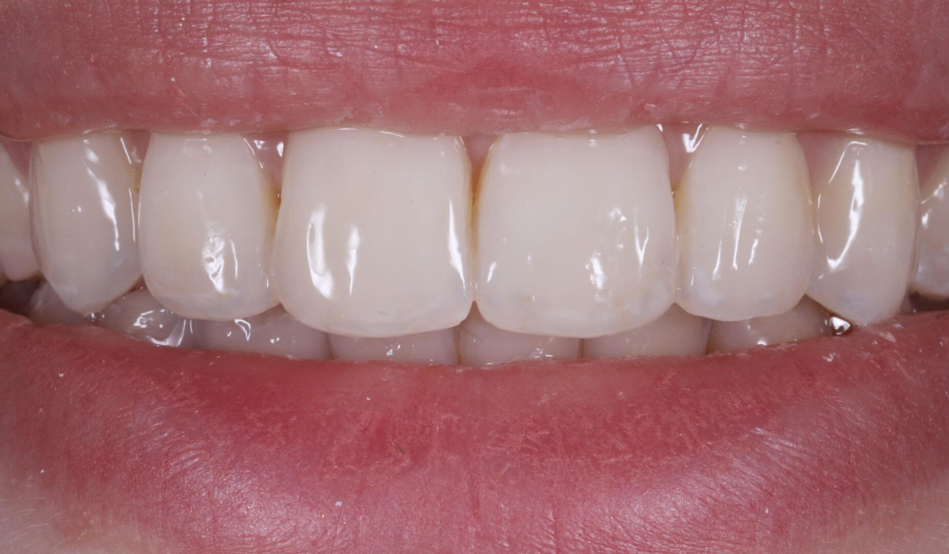 Результат после лечения