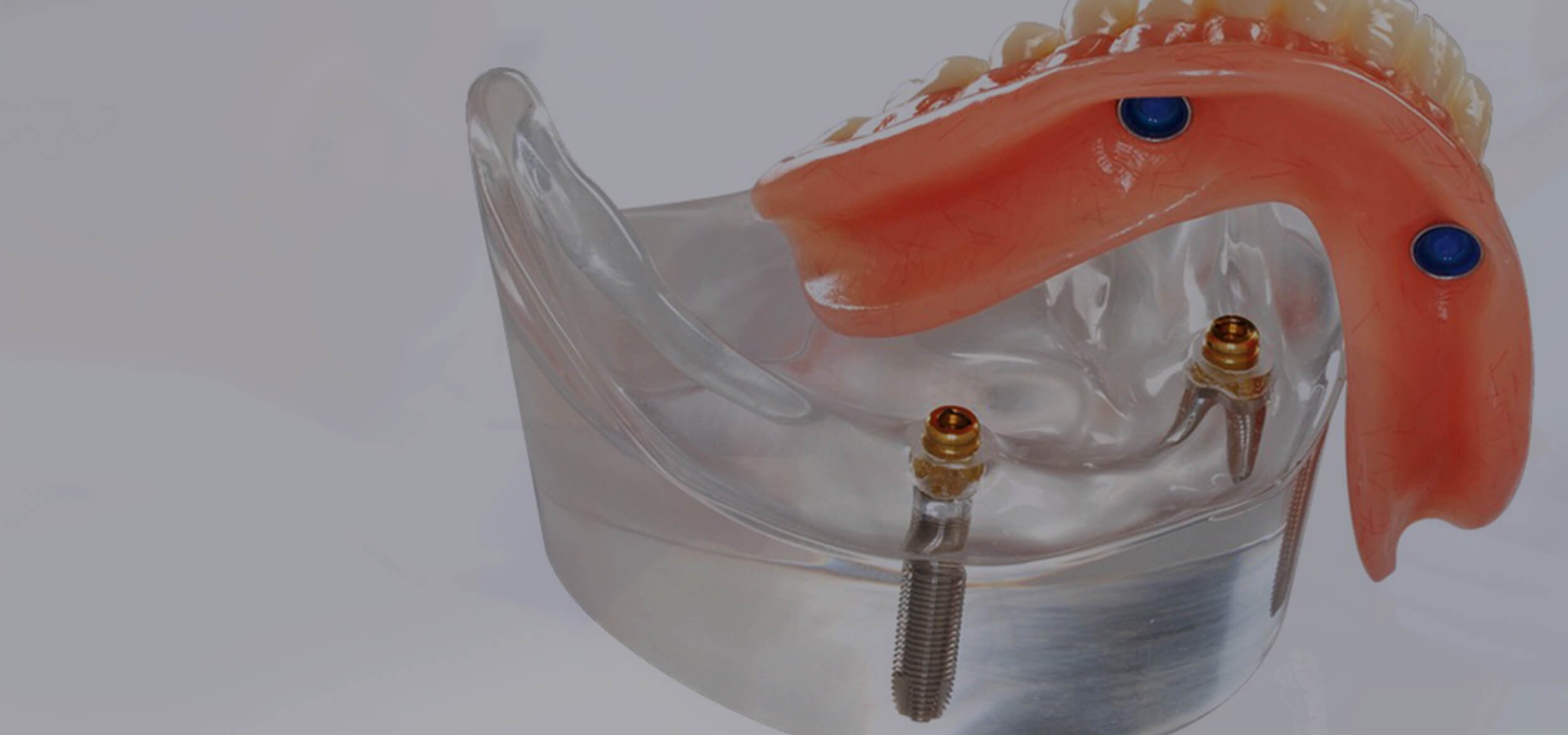 Протез на 2х имплантах